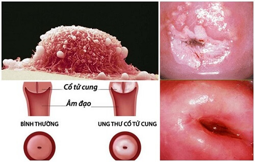 Bệnh viêm cổ tử cung mạn tính